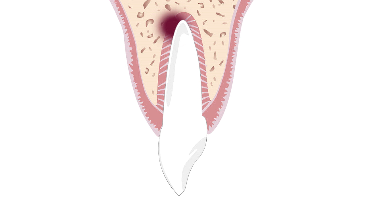 Grafik: Entzündung an der Zahnwurzelspitze